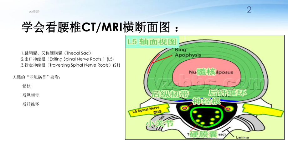 腰椎间盘突出影像-课件.ppt_第2页