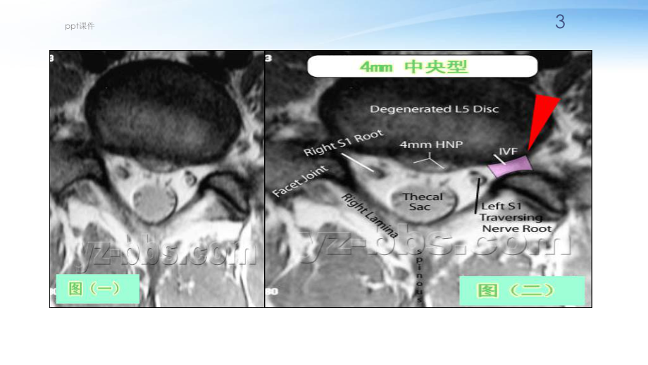 腰椎间盘突出影像-课件.ppt_第3页