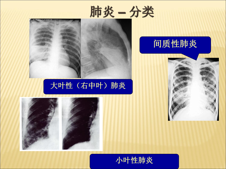 肺炎的诊断和治疗-课件.ppt_第2页