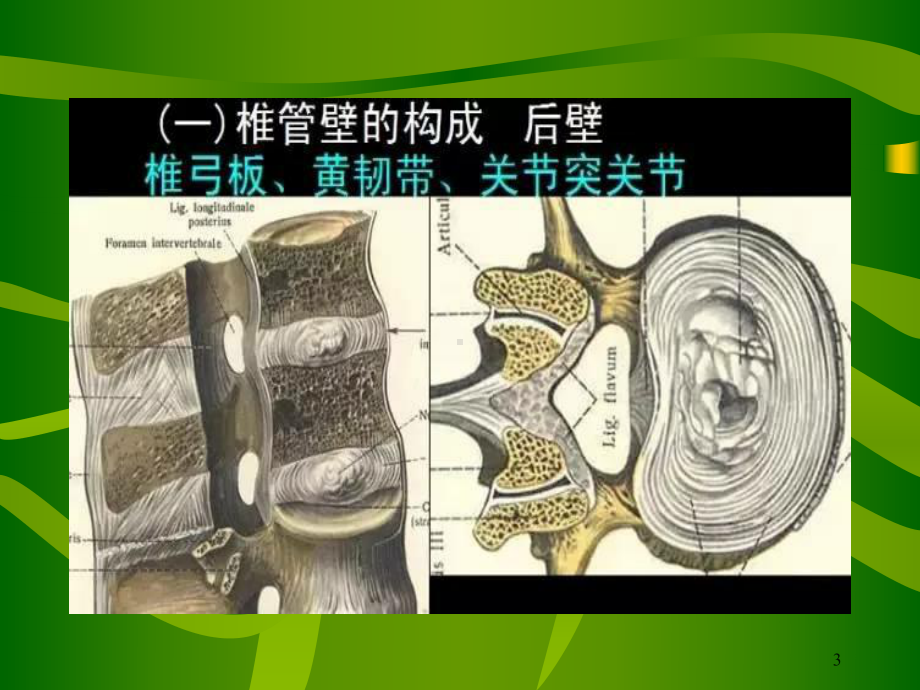 腰椎管狭窄症分析课件.ppt_第3页