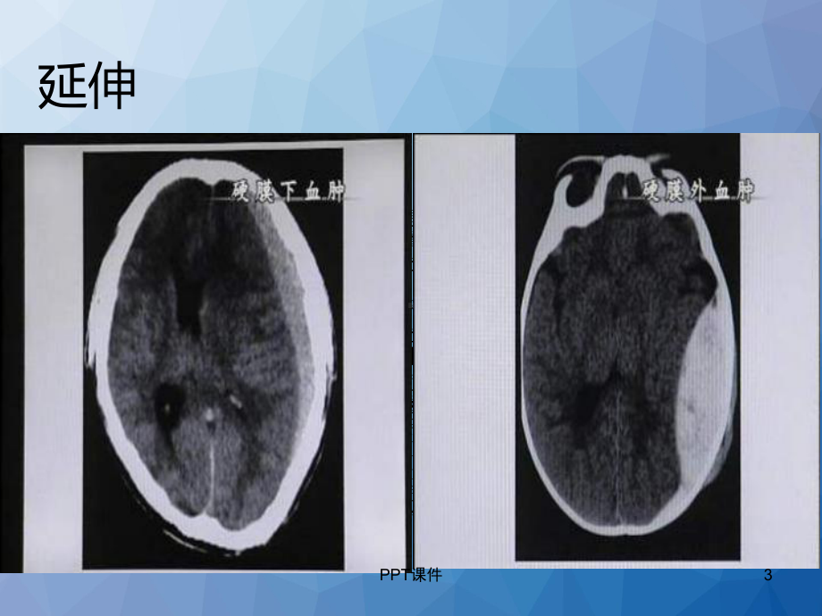 硬膜下血肿清除术-课件.ppt_第3页