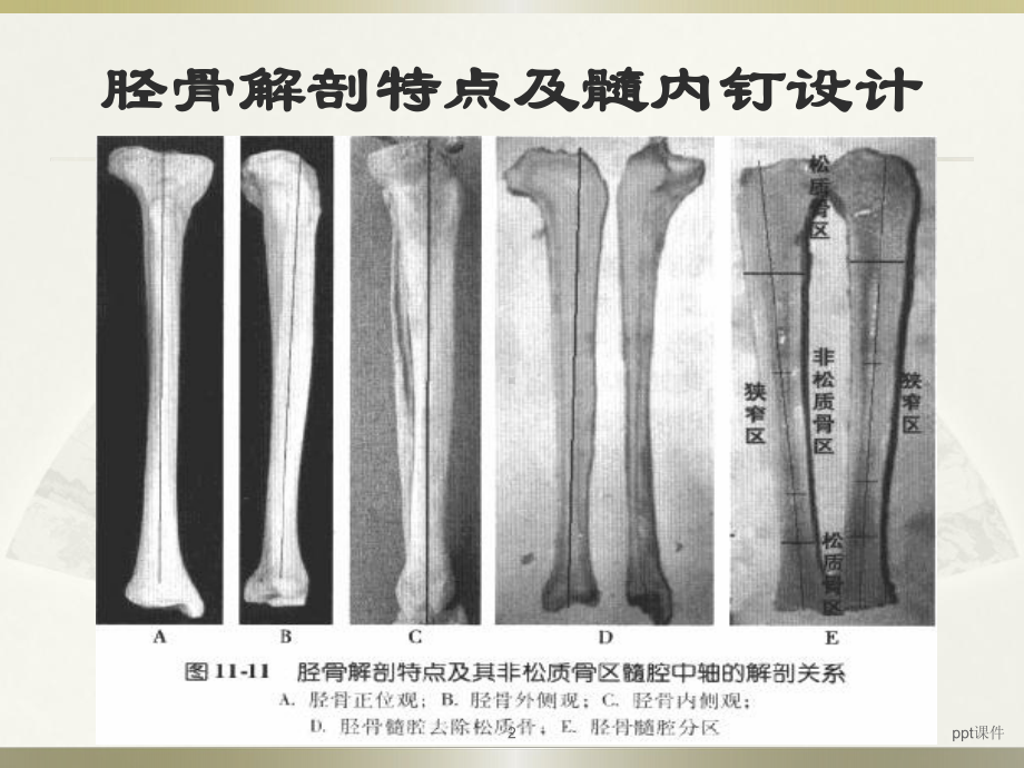 胫骨髓内钉内固定-课件.ppt_第2页