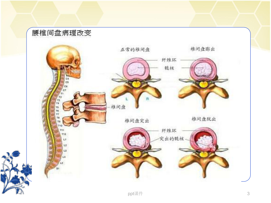 腰椎间盘突出症的护理-课件.ppt_第3页