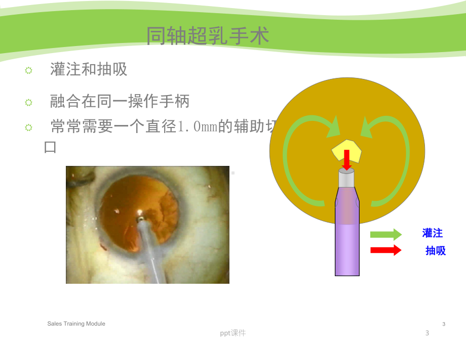 白内障手术过程及并发症-课件.ppt_第3页