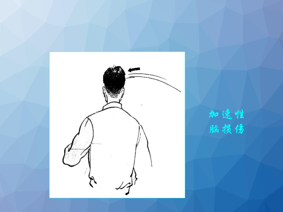 脑外伤-教学讲解课件.ppt_第3页