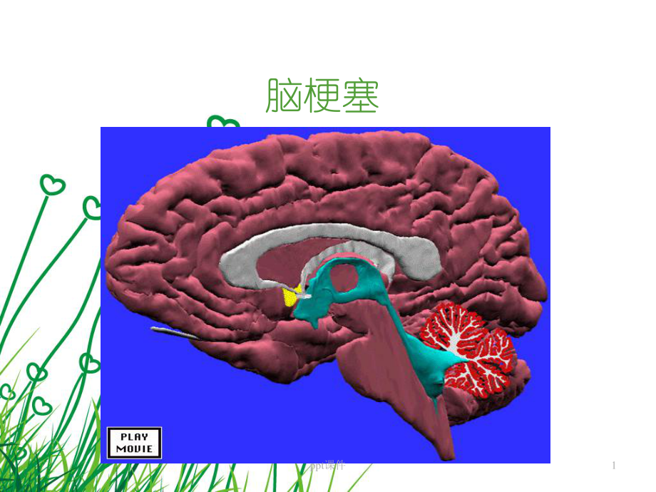 脑梗塞护理-课件.ppt_第1页