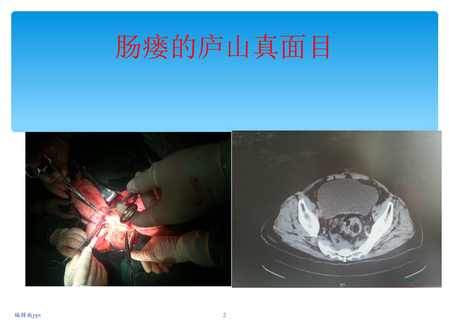 肠瘘治疗医学课件.ppt_第2页