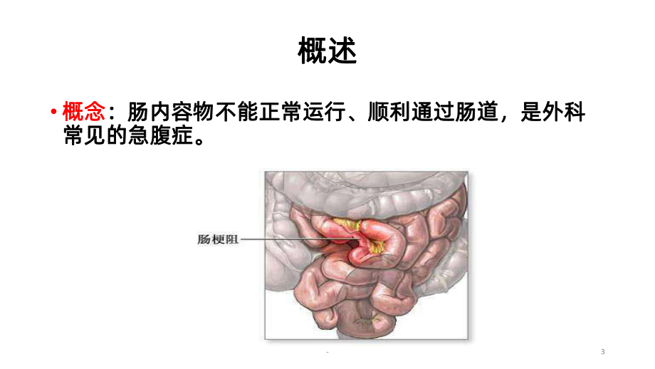 肠梗阻病人的护理课件(同名1337).pptx_第3页