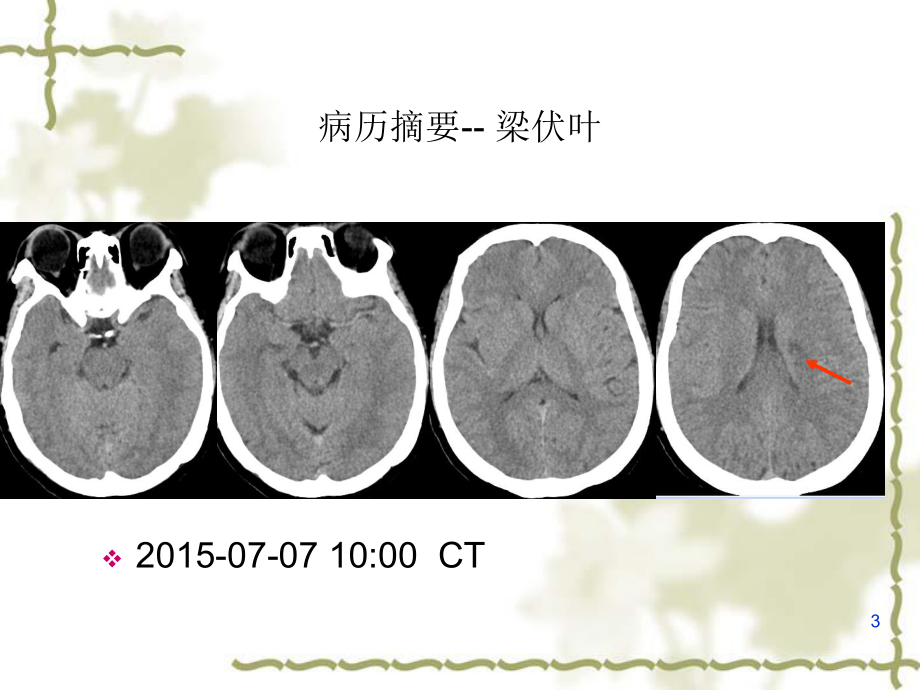 穿支动脉疾病姜备海课件.ppt_第3页