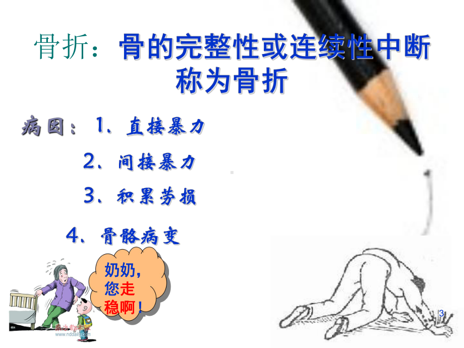 股骨粗隆间骨折的护理课件(同名769).ppt_第3页