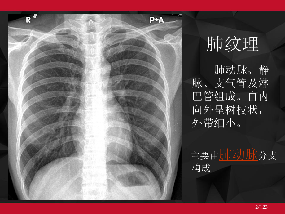 肺动脉栓塞影像诊断-课件.ppt_第2页