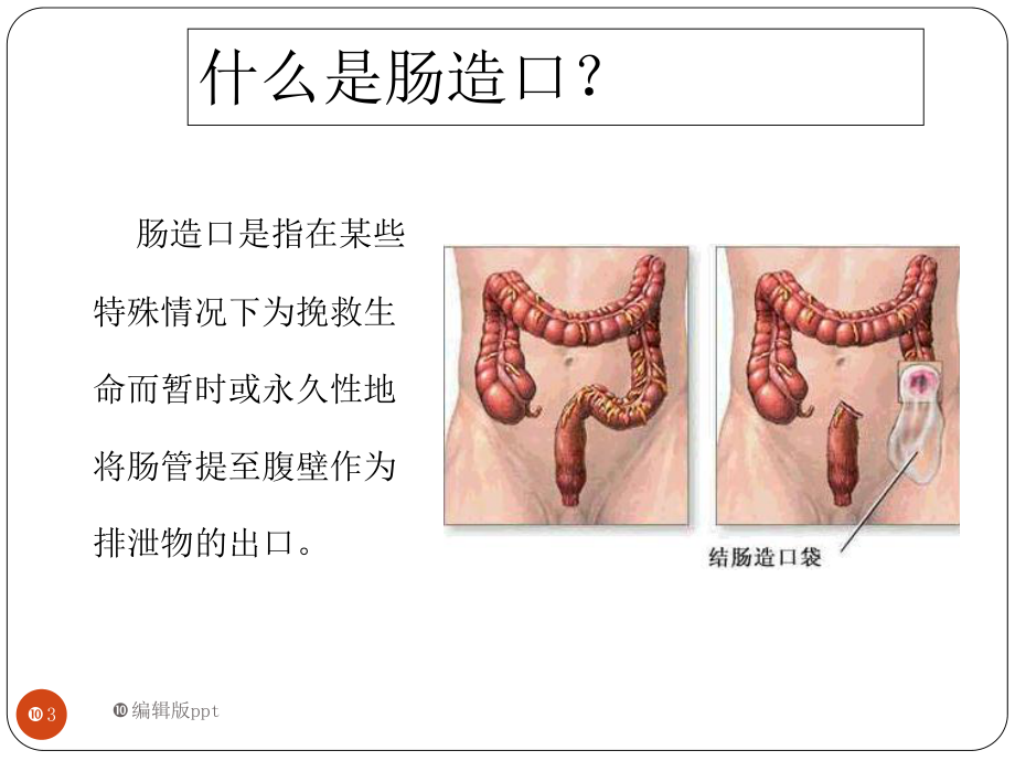 肠造口术医学课件.ppt_第3页