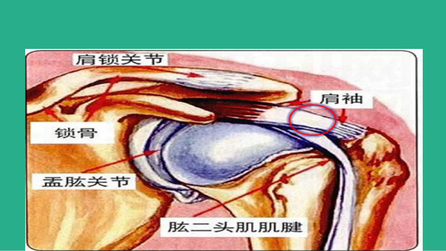 肩袖损伤的护理课件.ppt_第3页