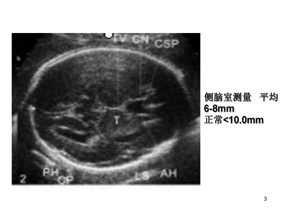 胎儿系统超声标准切面课件.ppt_第3页