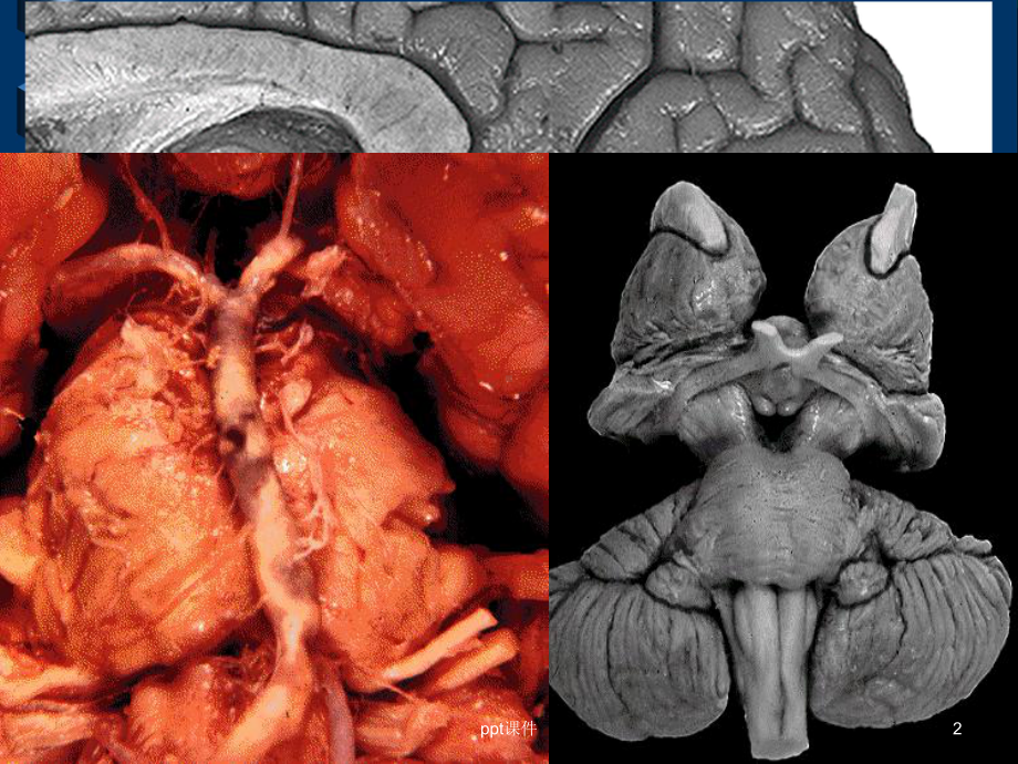 脑干解剖及脑干综合征-课件.ppt_第2页