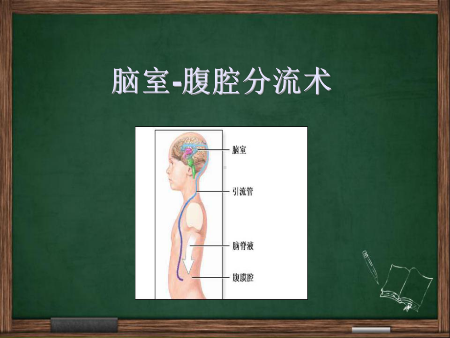 脑室腹腔分流术-课件.ppt_第1页