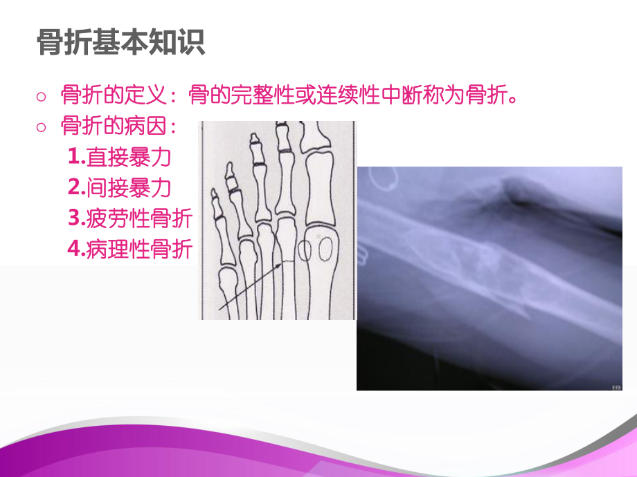 胫腓骨骨折（骨科）-课件.ppt_第2页