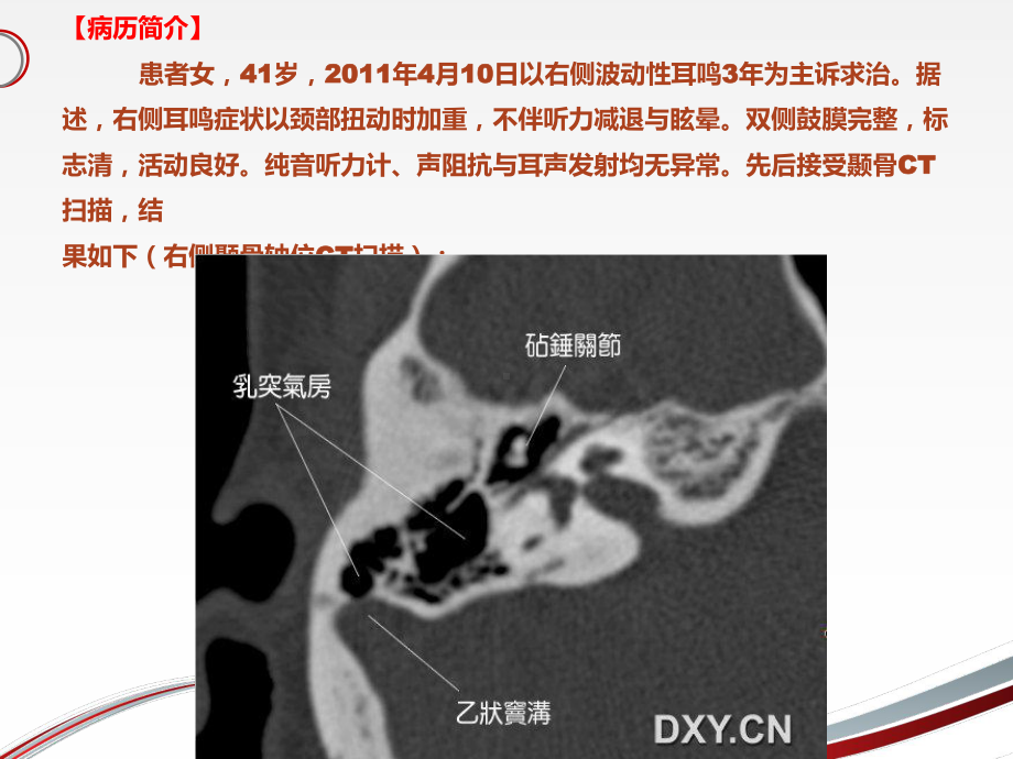 耳鸣与乙状窦憩室-课件.ppt_第2页