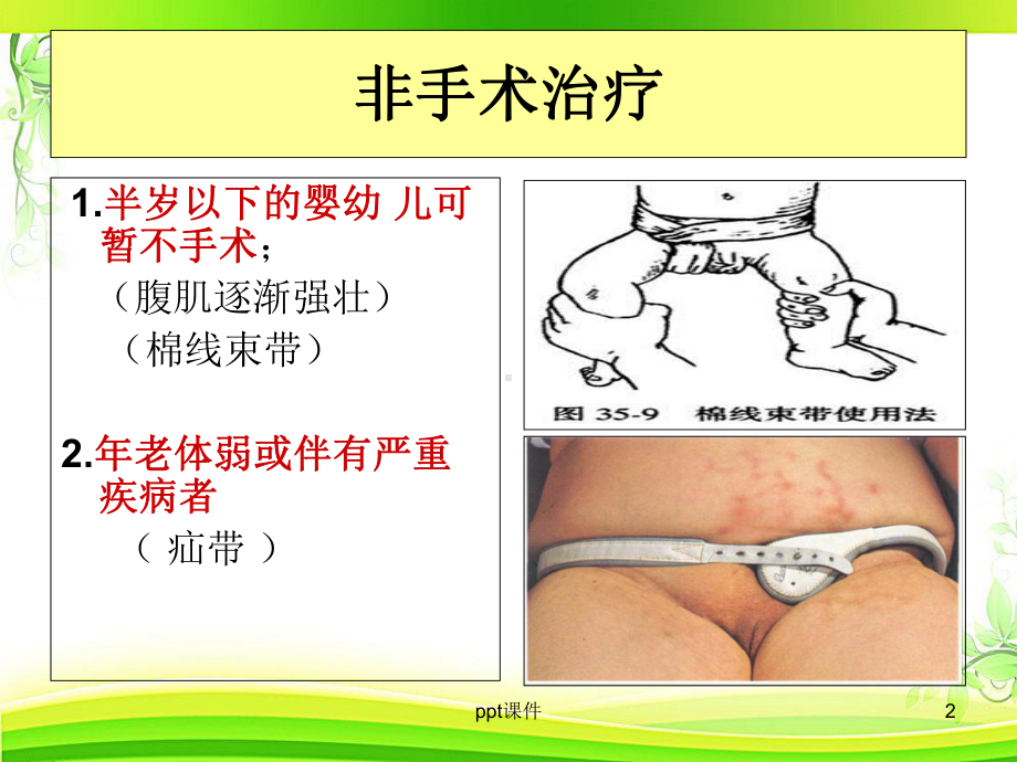 腹股沟疝手术-课件.ppt_第2页