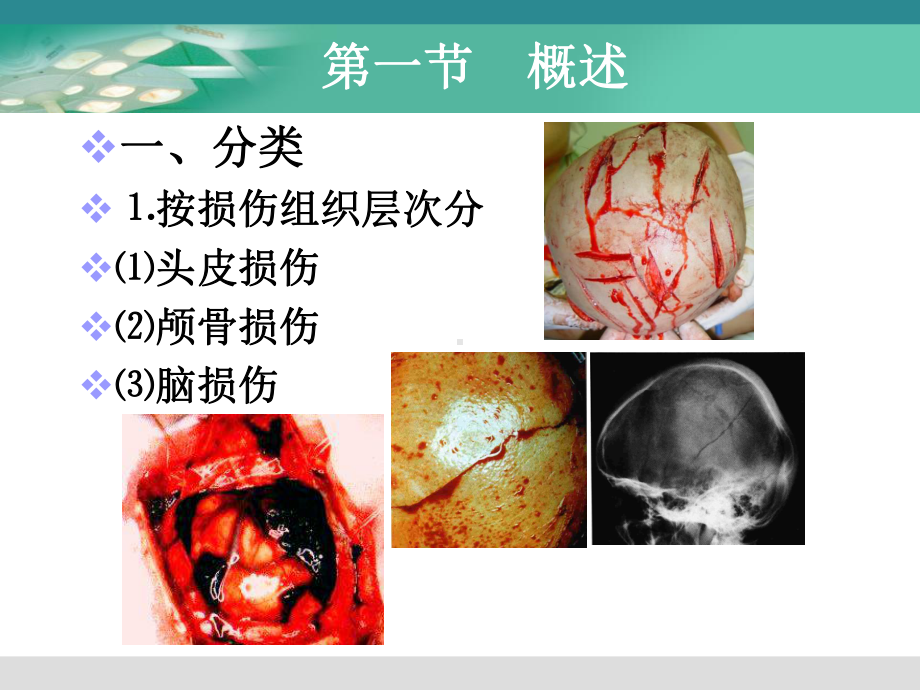 颅脑损伤模板课件.ppt_第3页