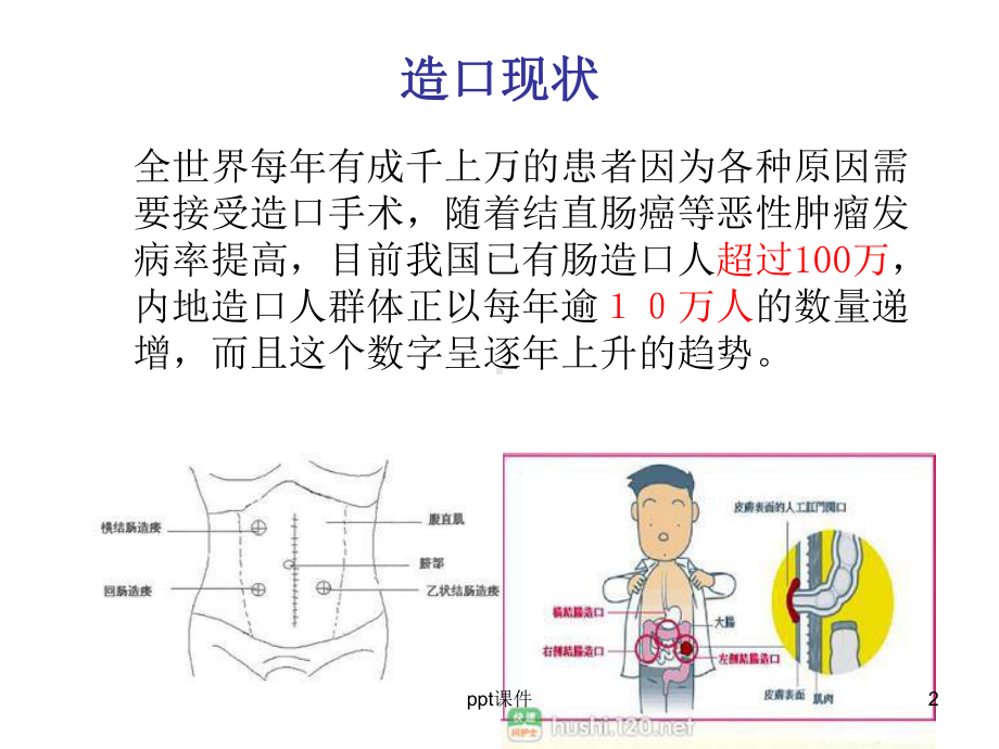 造口护理健康宣教-课件.ppt_第2页