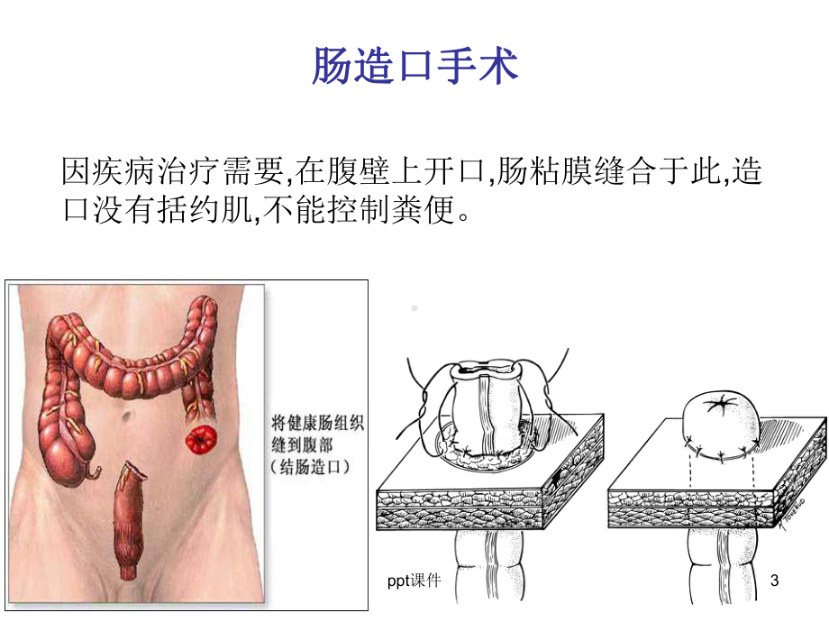 造口护理健康宣教-课件.ppt_第3页