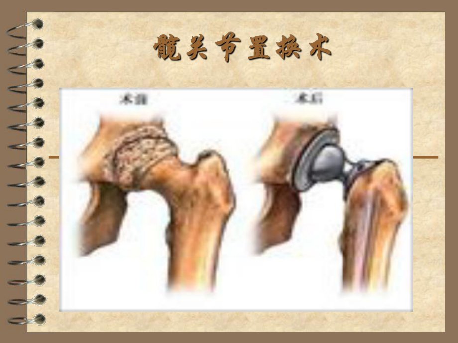 髋关节置换术康复课件.ppt_第1页