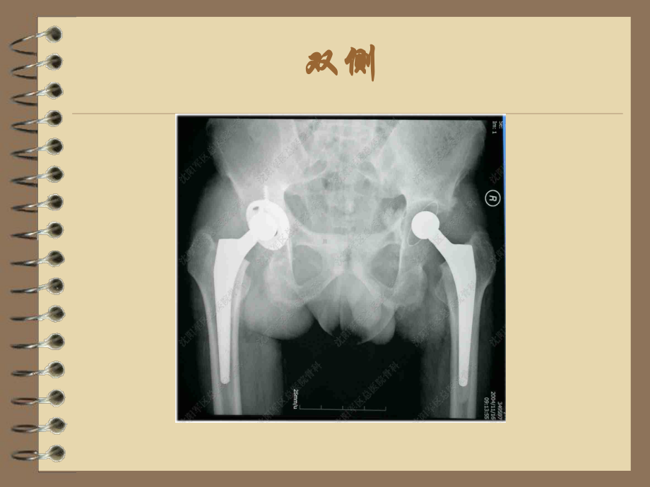 髋关节置换术康复课件.ppt_第3页