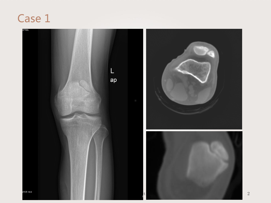 骨折漏诊误诊影像课件.ppt_第2页