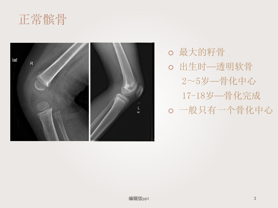 骨折漏诊误诊影像课件.ppt_第3页