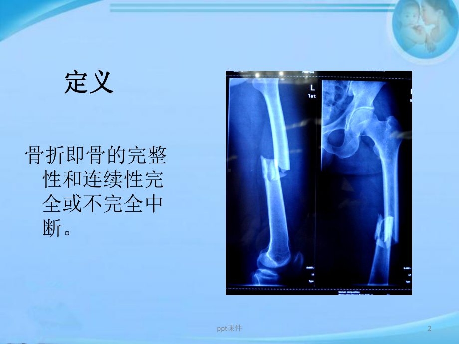 骨折X线表现-课件.ppt_第2页