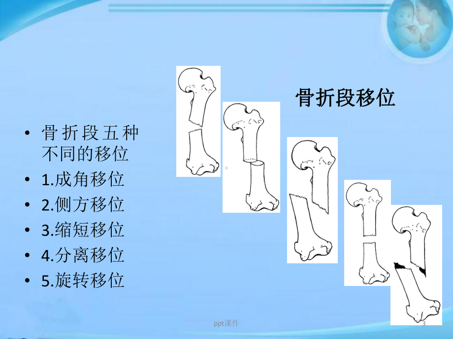 骨折X线表现-课件.ppt_第3页