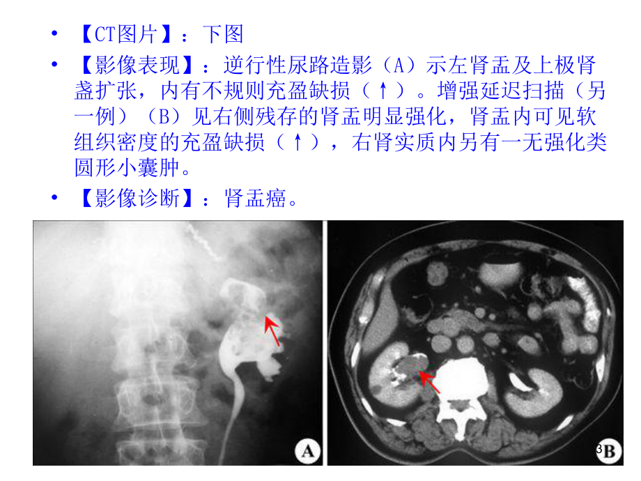 肾盂癌教学讲解课件.ppt_第3页