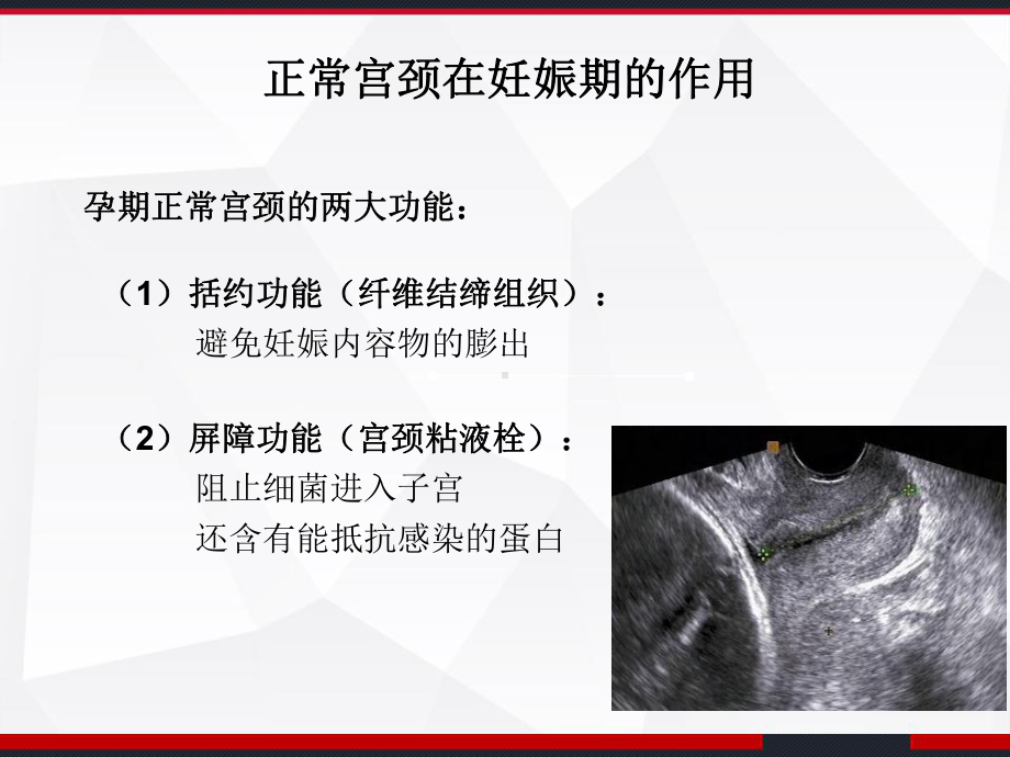 紧急宫颈环扎术的手术指征及术后管理-课件.ppt_第2页