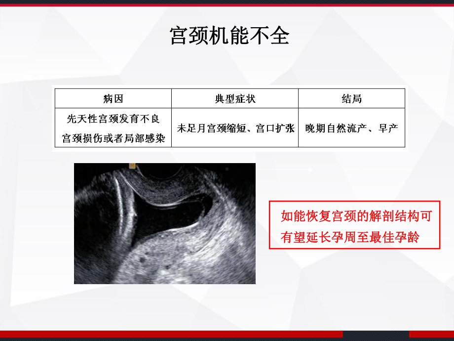 紧急宫颈环扎术的手术指征及术后管理-课件.ppt_第3页