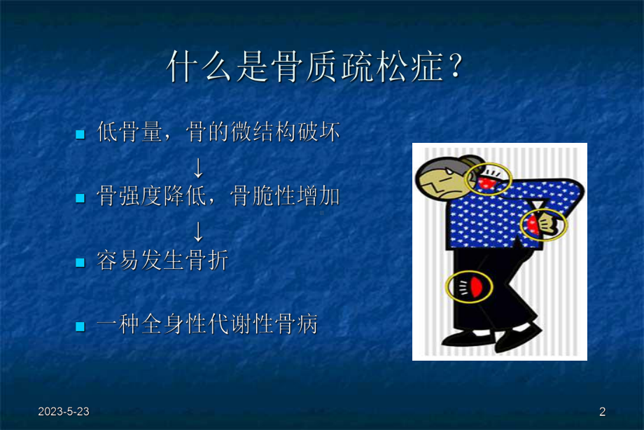 骨质疏松症课件(同名1437).ppt_第2页