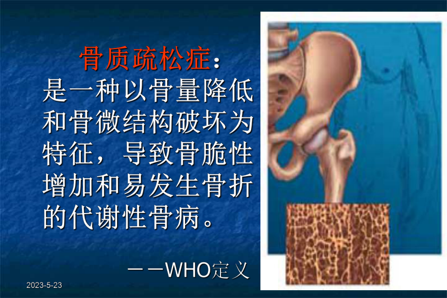 骨质疏松症课件(同名1437).ppt_第3页