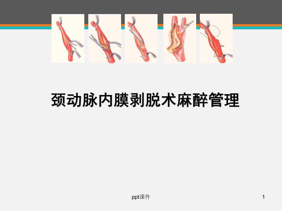 颈动脉内膜剥脱术麻醉管理-课件.ppt_第1页