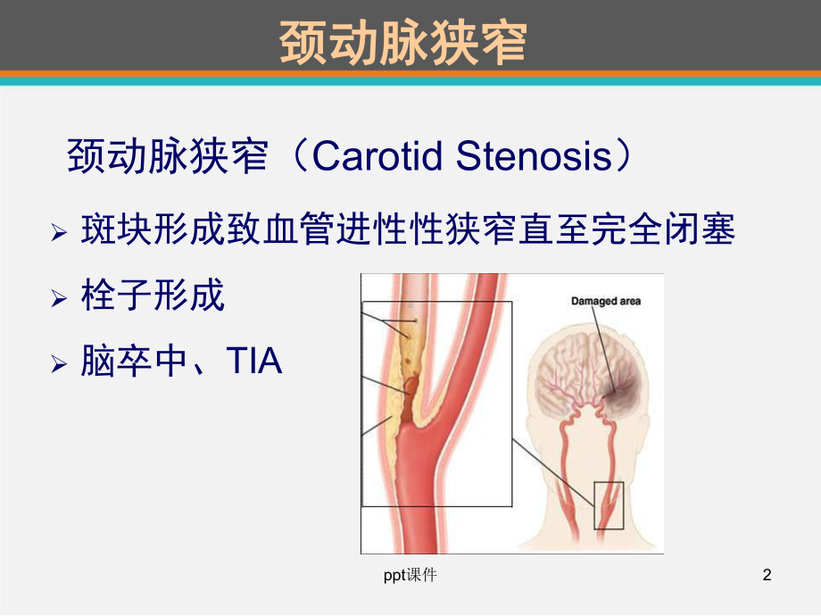 颈动脉内膜剥脱术麻醉管理-课件.ppt_第2页