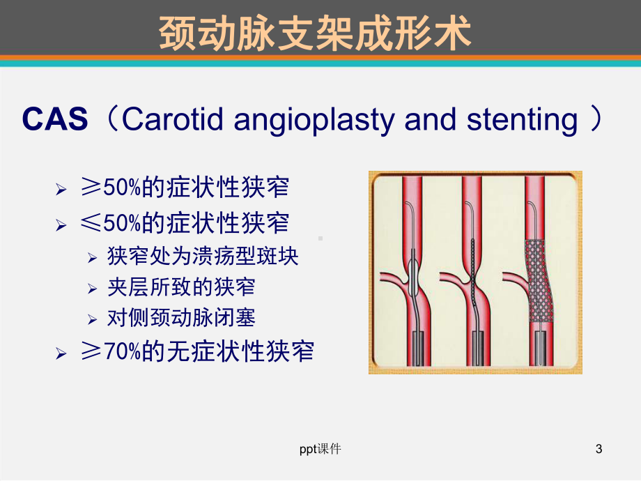 颈动脉内膜剥脱术麻醉管理-课件.ppt_第3页