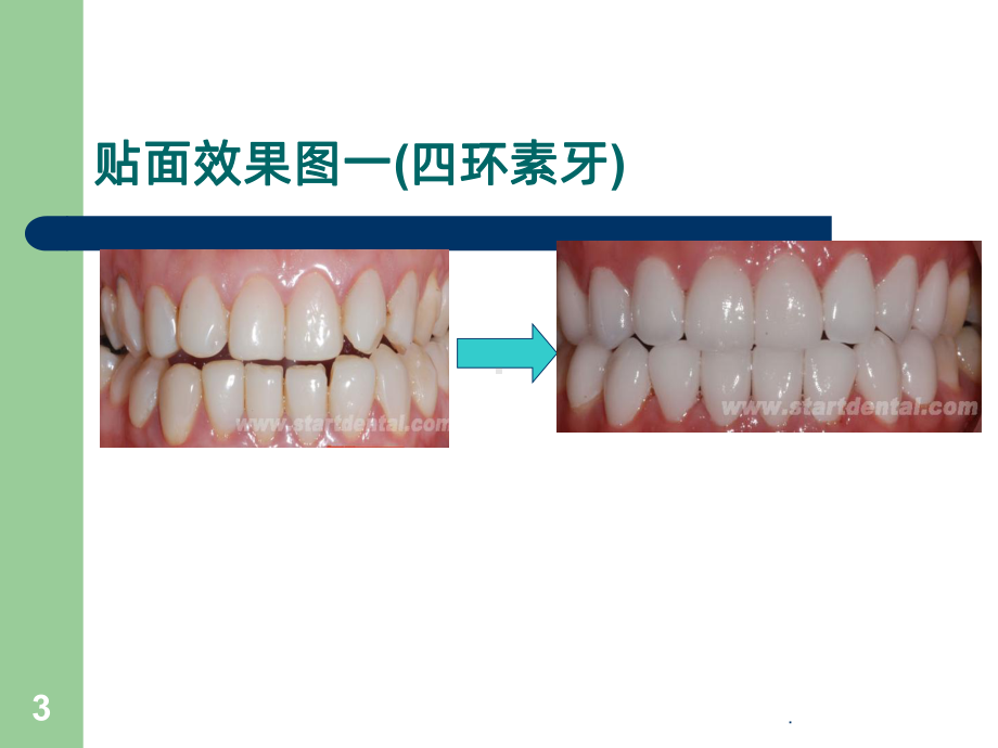 贴面研究课件.ppt_第3页