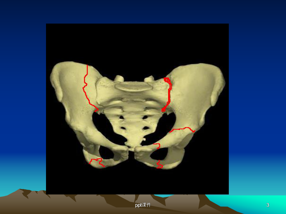 骨盆、髋臼骨折-课件.ppt_第3页