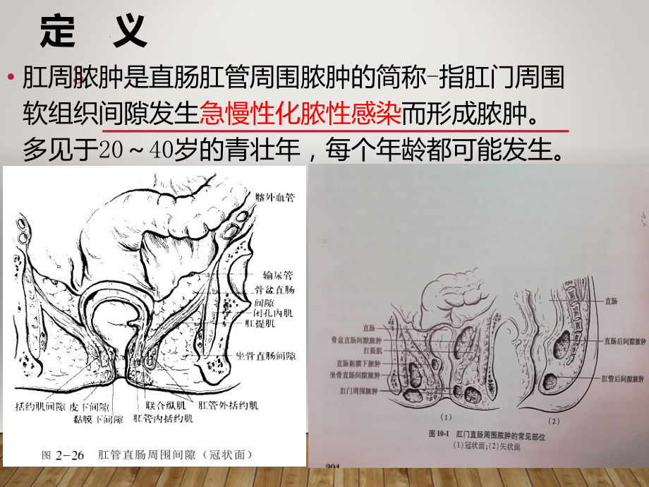 肛周脓肿课件(同名1331).ppt_第3页