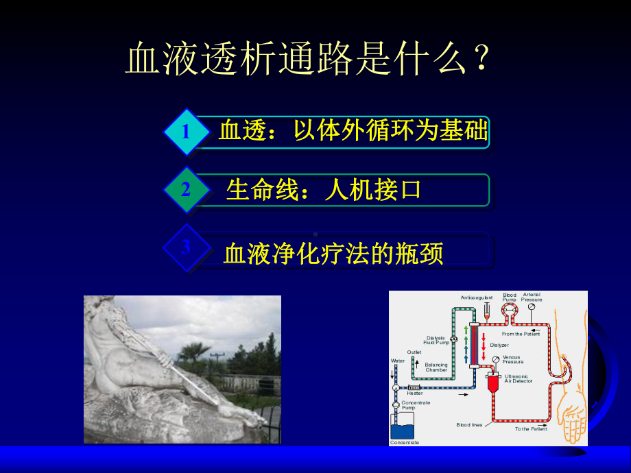 血液透析通路课件.ppt_第2页