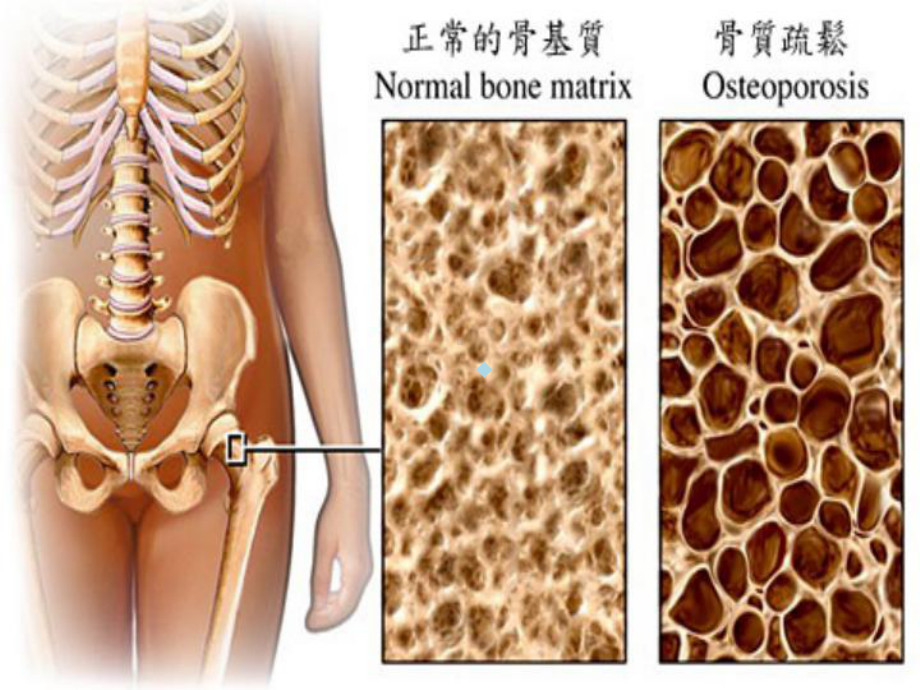 骨质疏松患者的护理课件-参考.ppt_第3页