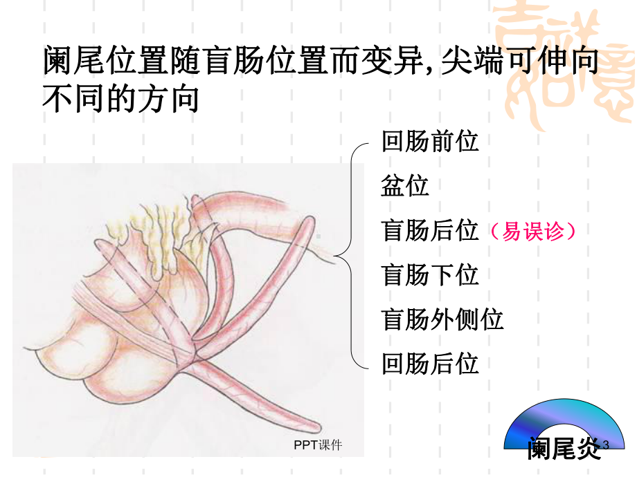 阑尾炎-教学讲解课件.ppt_第3页