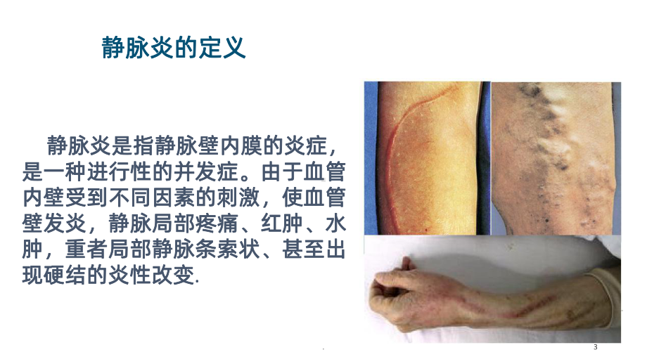 静脉炎的护理要点课件.ppt_第3页