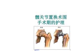 髋关节置换术围手术期的护理-课件.ppt