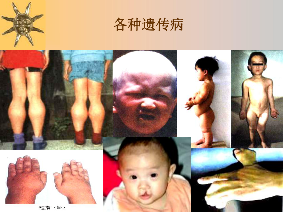 遗传病和遗传病的预防课件.ppt_第1页