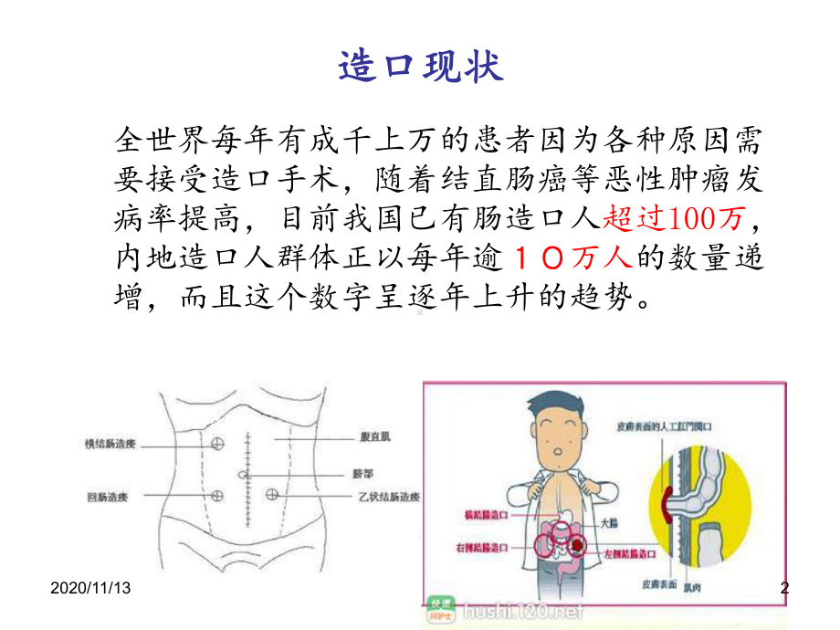 造口护理健康宣教-课件.pptx_第2页